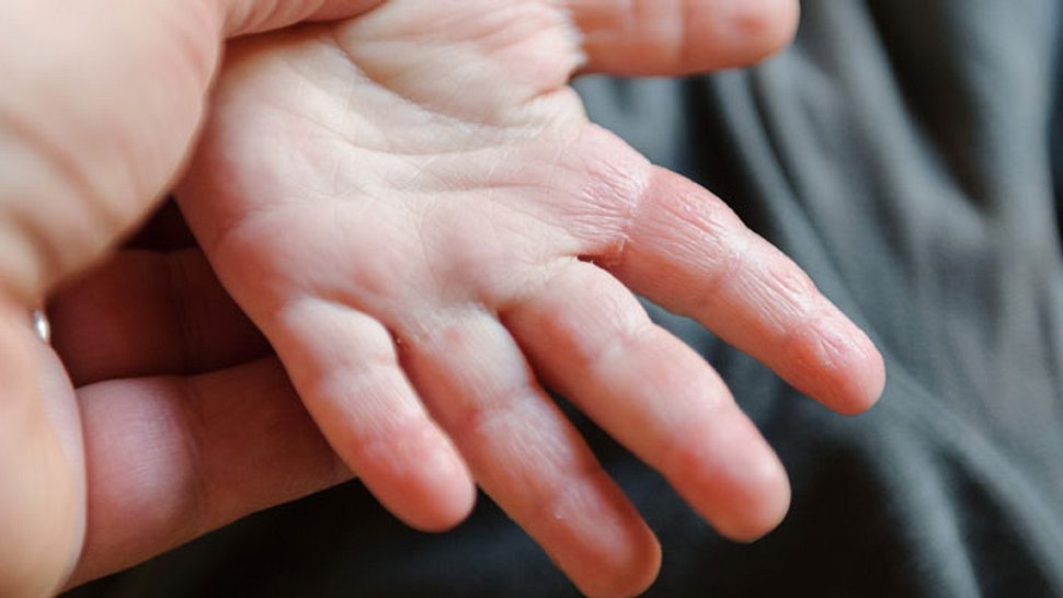 Hand-Fuß-Mund-Krankheit Symptom Ausschlag an den Händen - Foto: Shutterstock