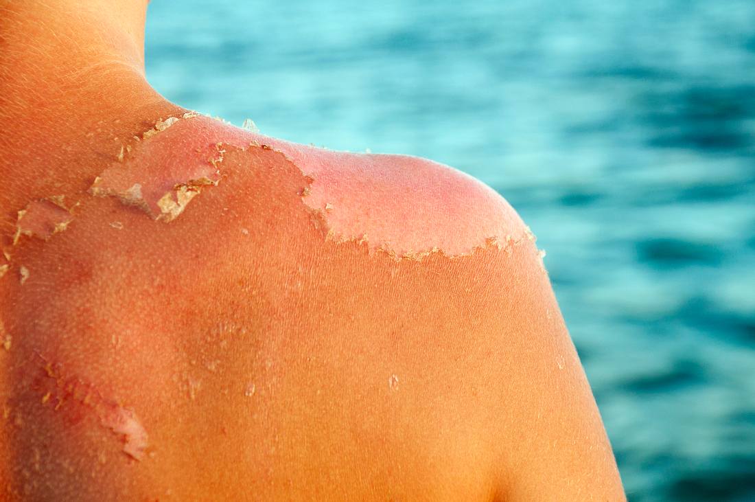 Haut schält sich nach einem Sonnenbrand