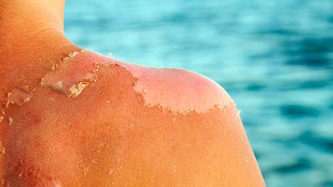 Haut schält sich nach einem Sonnenbrand - Foto: iStock_Barcin