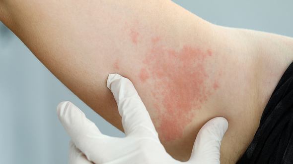 Nahaufnahme eines Oberarms mit Hautausschlag, eine Hand mit Schutzhandschuhen weist auf die Stelle - Foto: istock/Ivan-balvan
