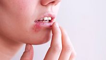 Eine Person mit Herpes an der Lippe. - Foto: iStock / koto_feja
