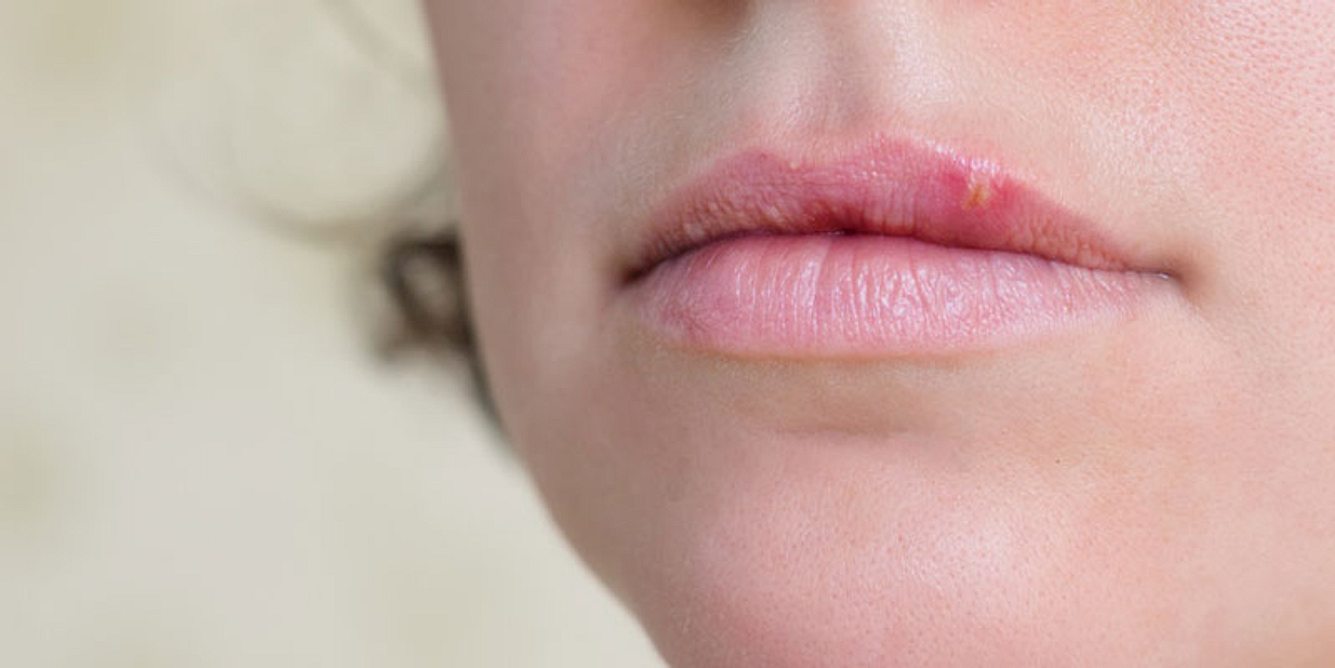 Herpes an der Lippe