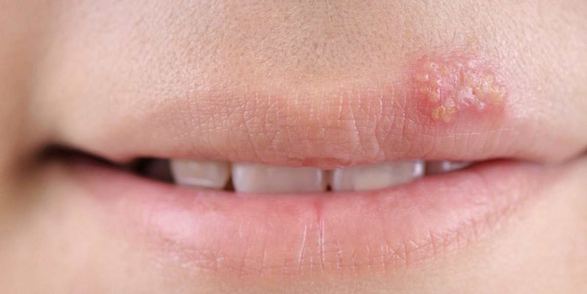 Herpes an der Lippe eines Patienten