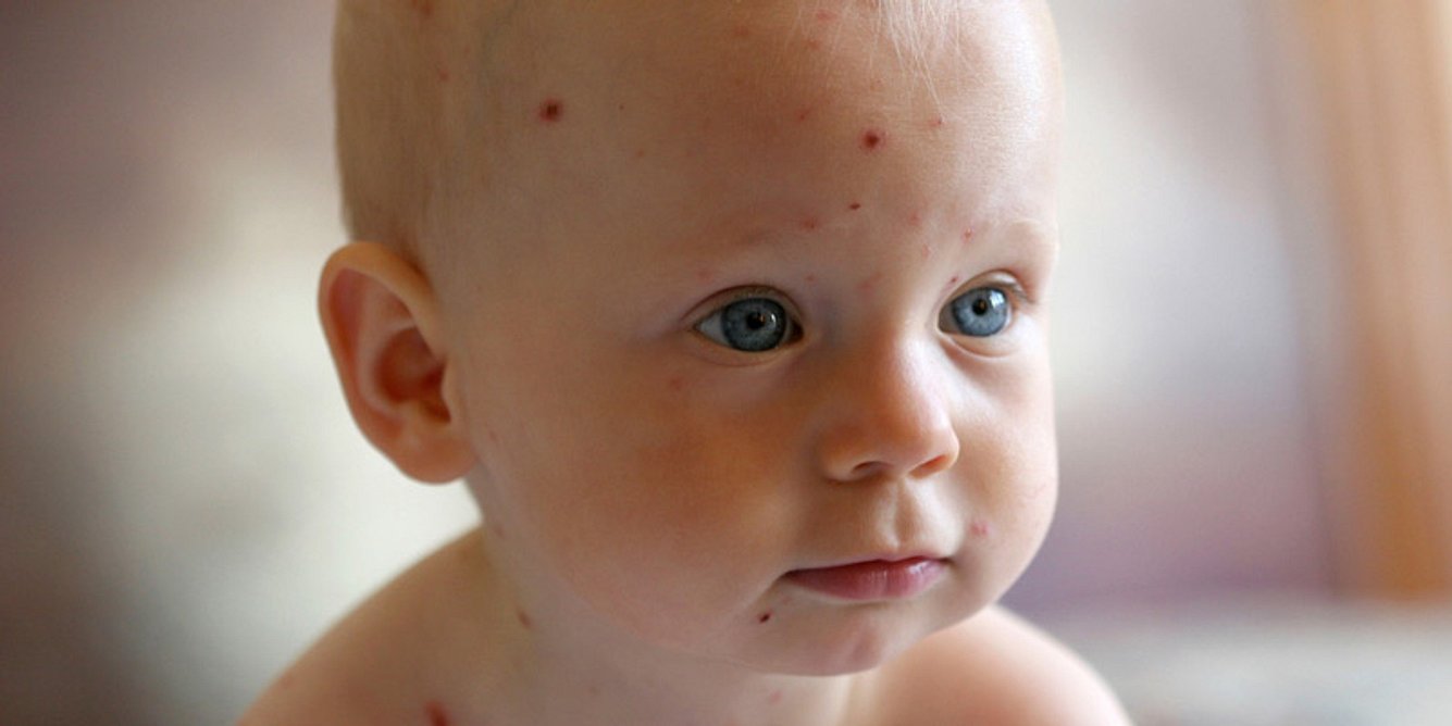 Herpes Zoster nach Windpocken