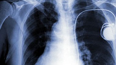 Herzschrittmacher bei Herzrhythmusstörungen - Foto: shutterstock
