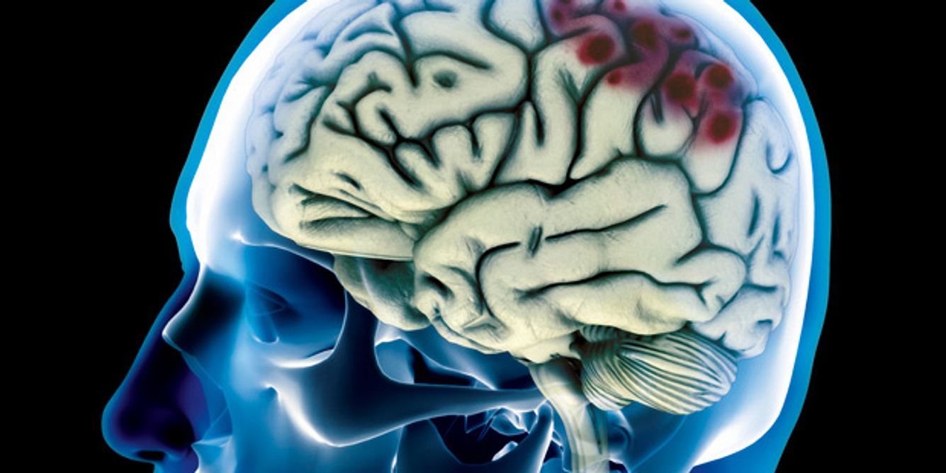 Eine häufige Ursache bei einer Hirnblutung ist das Schädel-Hirn-Trauma infolge eines Aufpralls