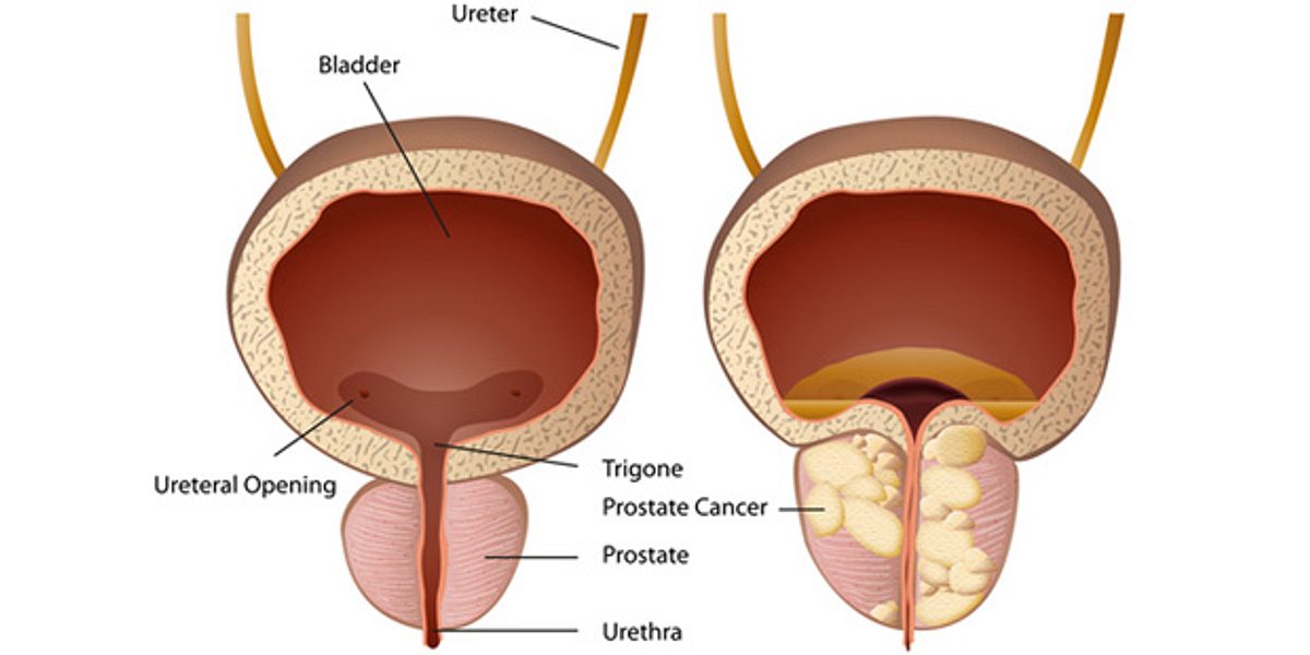 Illustration: links eine gesunde Prostata, rechts Prostatakrebs