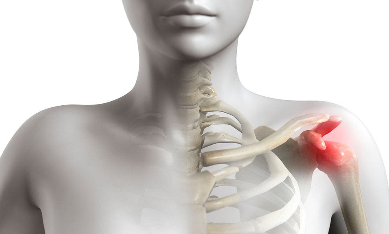 Impingement Schulter