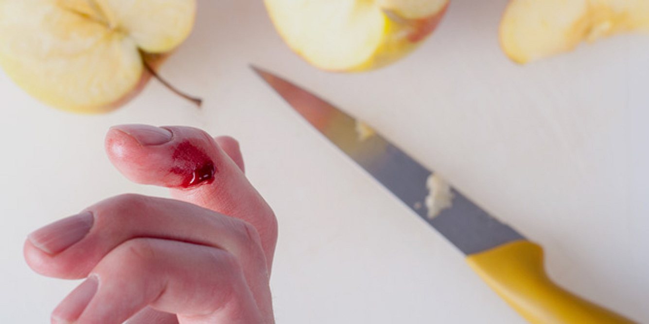 Apfelstücke, ein Messer und ein Finger mit Schnittwunde