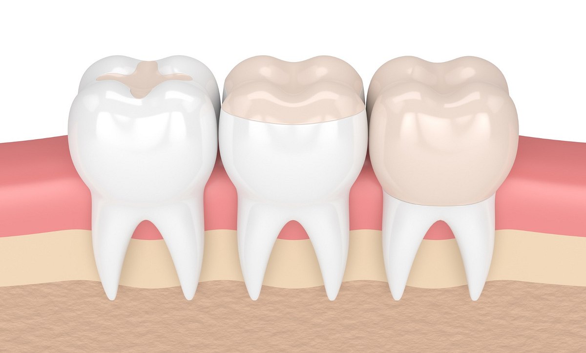 Illustration von Zähnen mit Inlays