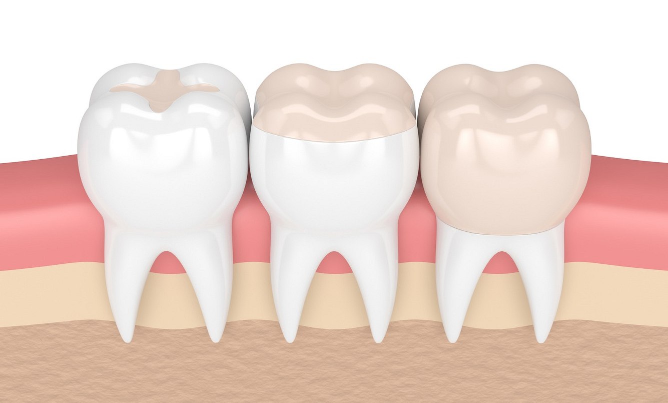 Illustration von Zähnen mit Inlays
