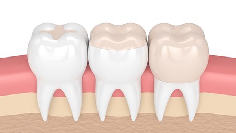 Illustration von Zähnen mit Inlays - Foto: istock_ayo888