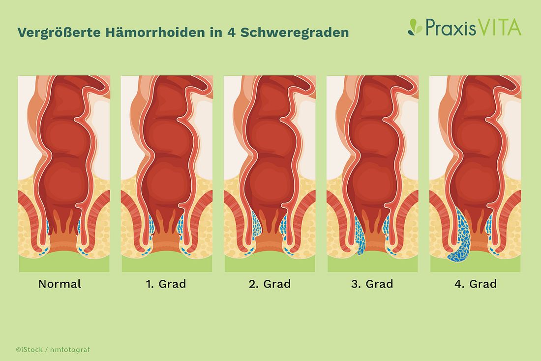 innere-haemorrhoiden-grafik Grafik vergrößerte Hämorrhoiden