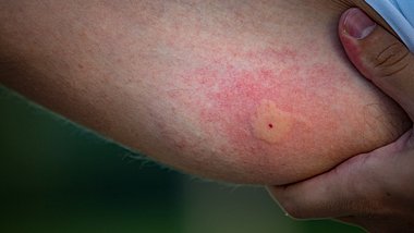Geschwollener Insektenstich am Arm - Foto: iStock/kmatija