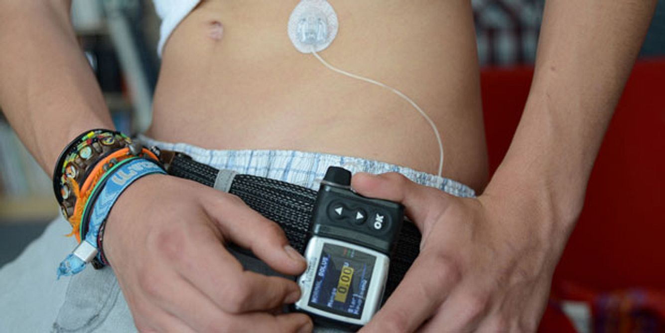 Diabetes-Behandlung mit Insulinpumpe
