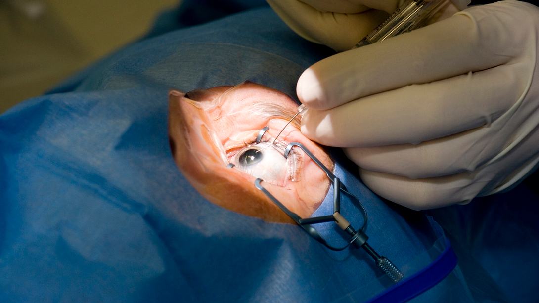 Ärzt:innen operieren am Auge - Foto: Istock/LuisPortugal