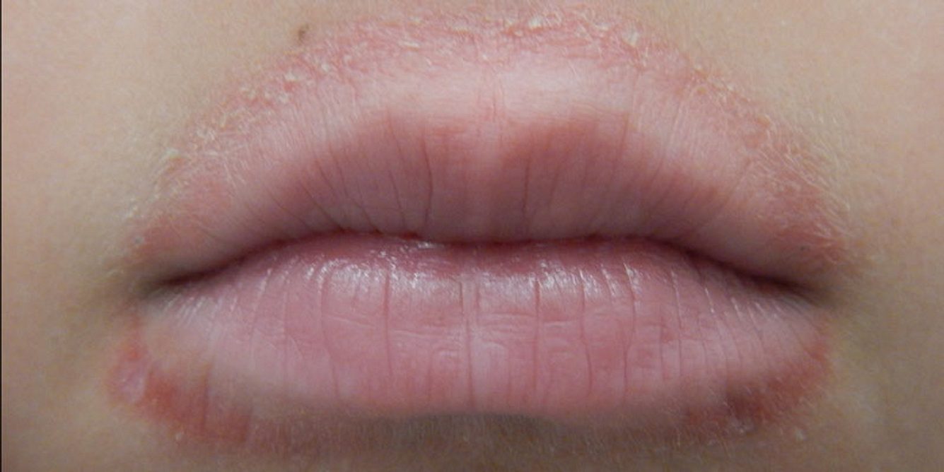 Leck-Ekzem, Schnuller-Ekzem oder periorale Dermatitis beim Kind: Pickel um den Mund