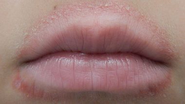 Leck-Ekzem, Schnuller-Ekzem oder periorale Dermatitis beim Kind: Pickel um den Mund - Foto: James Heilman, MD – CC BY-SA 4.0