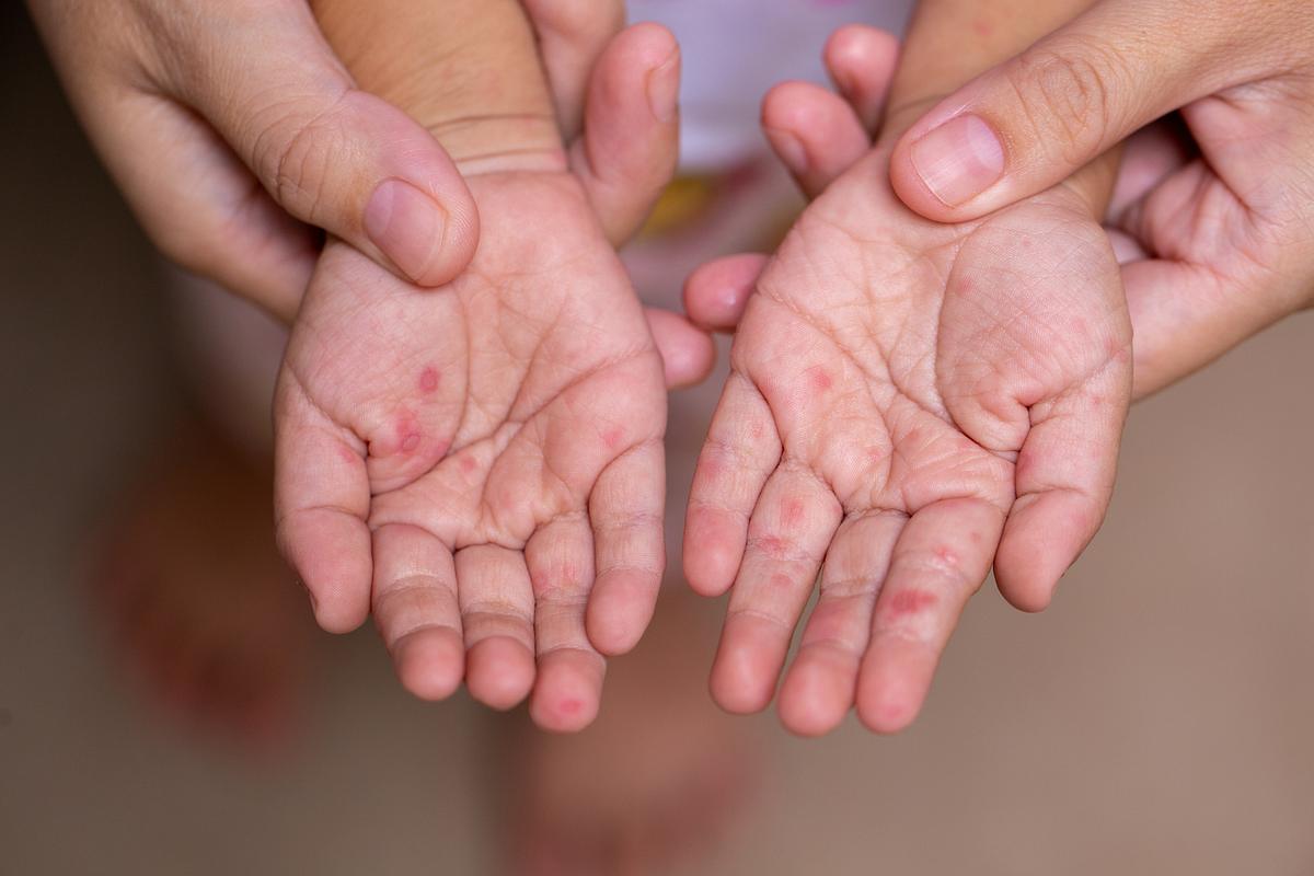 Kind mit roten Flecken auf den Handinnenflächen