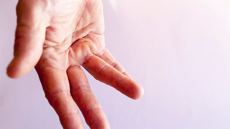 Hand mit einem gekrümmten Finger durch Morbus Dupuytren - Foto: iStock/PeterTG