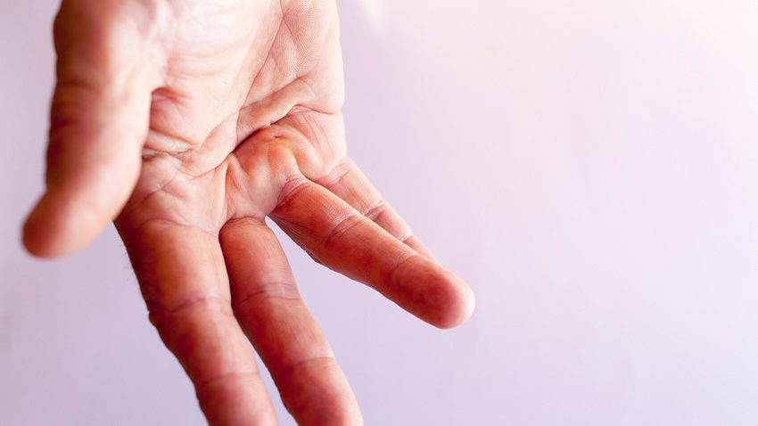 Hand mit einem gekrümmten Finger durch Morbus Dupuytren - Foto: iStock/PeterTG