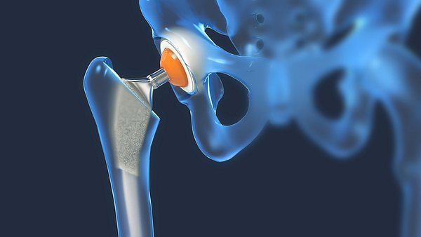 Künstliches Hüftgelenk - Foto: iStock/Christoph Burgstedt