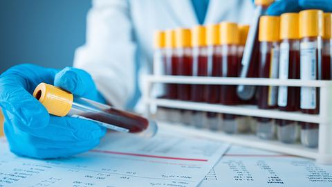 Im Labor: Hand mit Schutzhandschuhen hält Probenröhrchen mit Blut, daneben weitere Blutproben - Foto: istock/busracavus