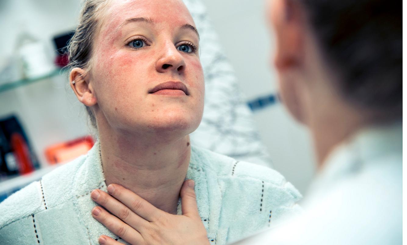 Bei einer Kontaktallergie reagiert der Körper mit Irritationen der Haut