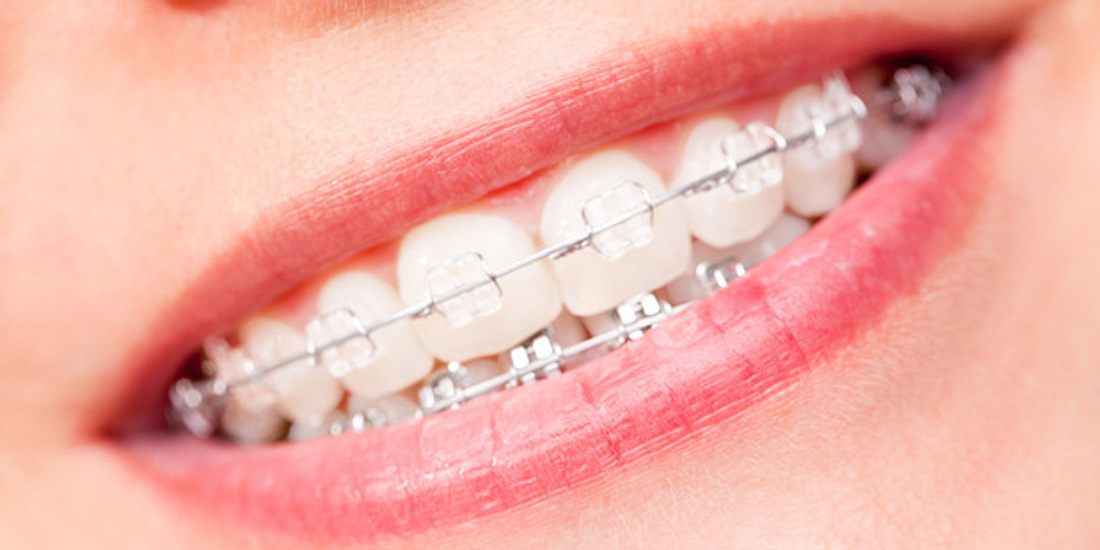 Kopfschmerzen können eventuell durch schiefe Zähne ausgelöst werden