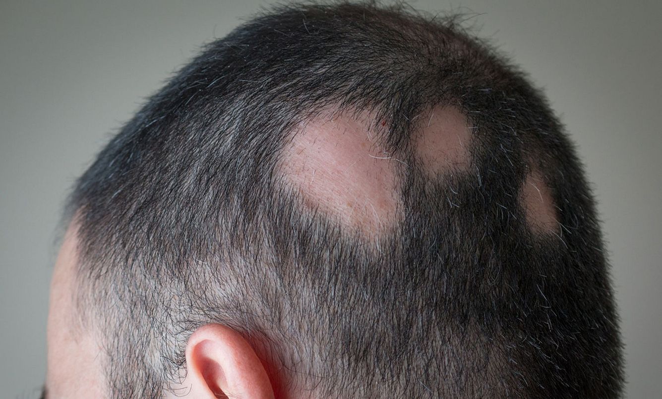 Mann mit kreisrundem Haarausfall