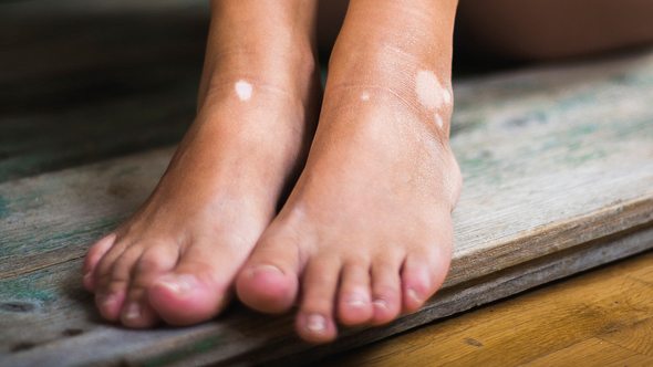 Füße mit Pigmentstörungen - Foto: iStock/Jela