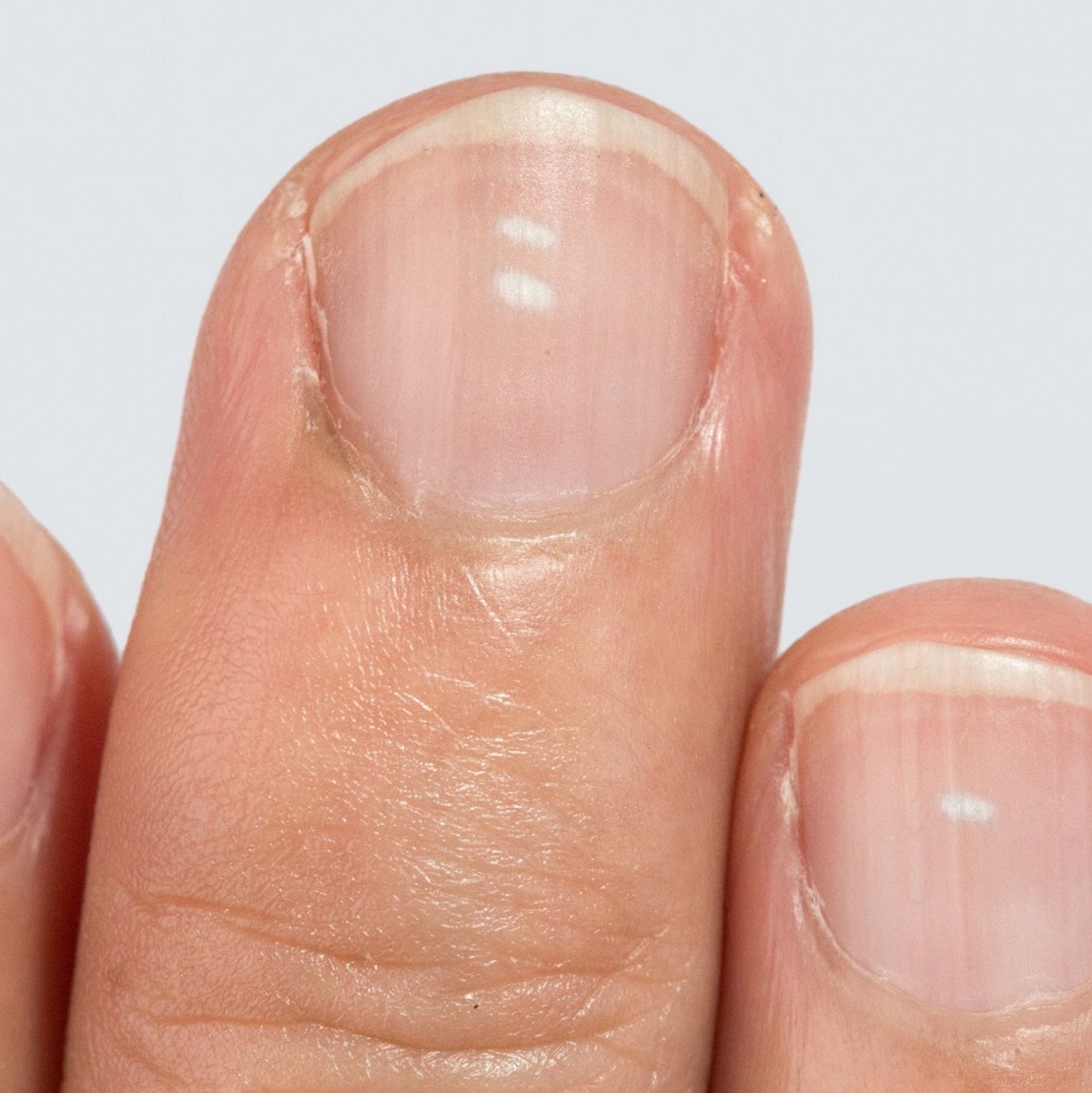 Почему полоски на ногтях рук