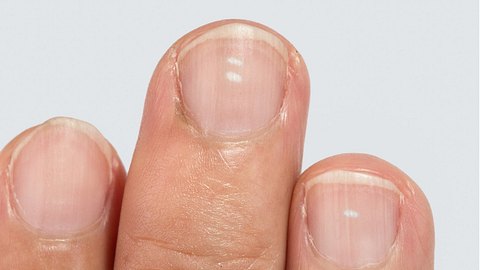 Fingernägel mit Längsrillen - Foto: Toa55