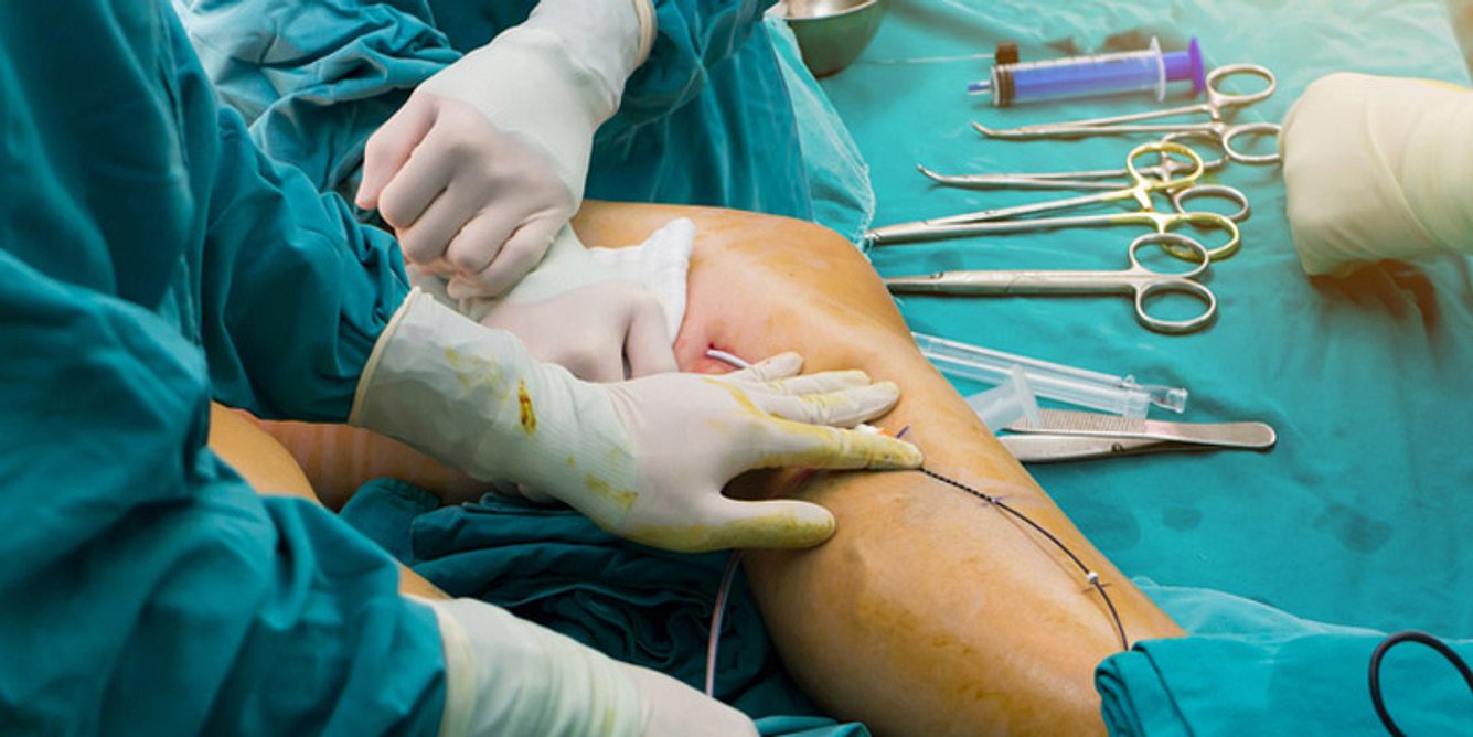 Bei der Liposuktion wird ein schmerzhaftes Lipödem an den Beinen entfernt