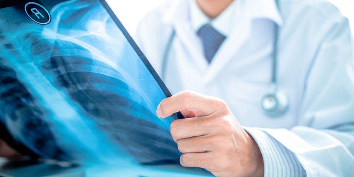 Arzt untersucht Lunge auf Röntgenbild