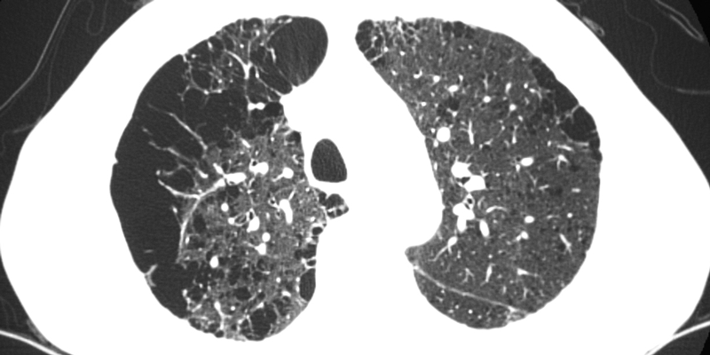 Mit Hilfe von diagnostischen Verfahren wie der CT-Angiographie wird die Wahrscheinlichkeit für das Vorliegen einer Lungenembolie bestimmt