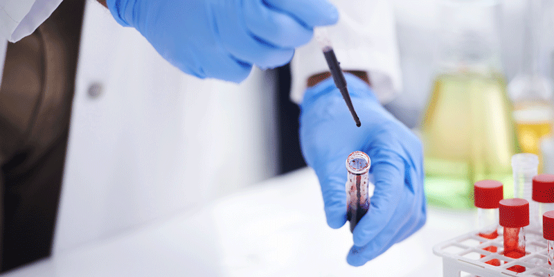 Wird die Wahrscheinlichkeit für das Vorliegen eines Arterienverschlusses als mittel oder niedrig eingestuft, wird zur weiteren Lungenembolie-Diagnose zunächst ein D-Dimer-Bluttest angeordnet