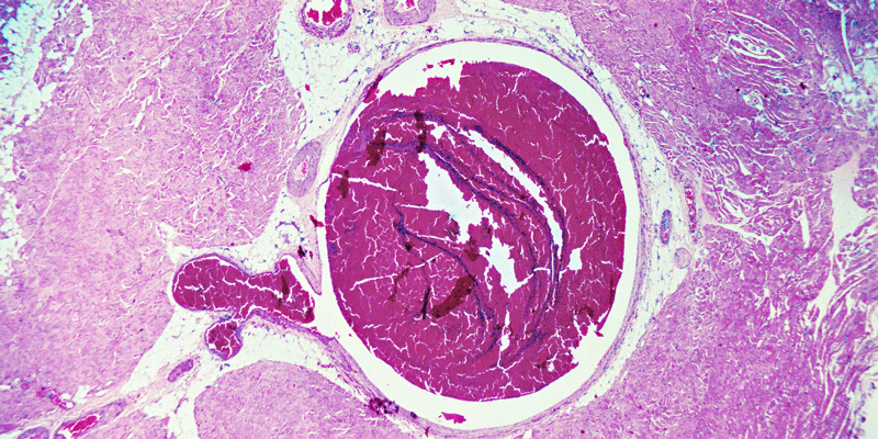 Die häufigste Ursache für eine Lungenembolie sind in die Lungenarterien eingeschwemmte Blutgerinnsel