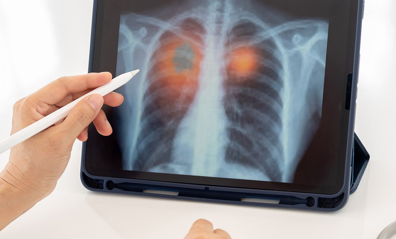 Hand zeigt mit einem Stift auf ein Tablet, auf welchem ein Bild der Lunge zu sehen ist
