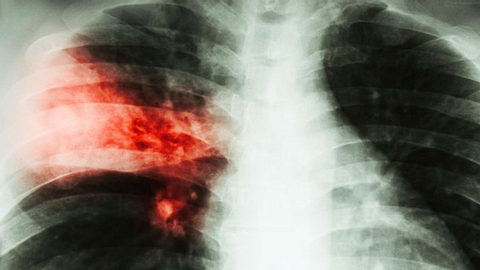 Lungenentzündung - Foto: iStock