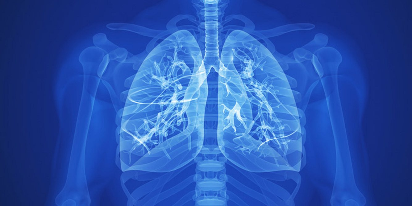 Bei einem Lungeninfarkt ist die Durchblutung des Lungengewebes vermindert oder gänzlich aufgehoben