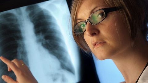 Wie verläuft die Lungenkrebs-Behandlung?