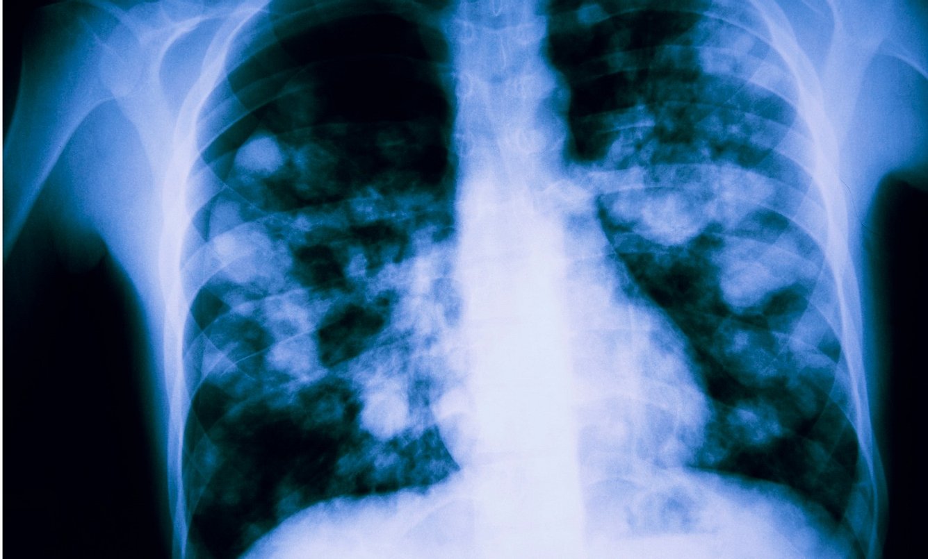 Mithilfe einer Röntgenuntersuchung lässt sich ein Lungenödem feststellen