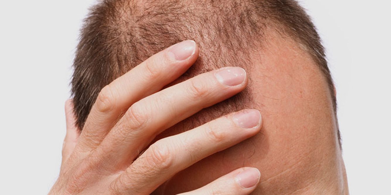 Ein Mann mit Haarausfall