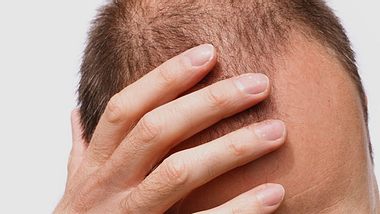 Ein Mann mit Haarausfall - Foto: iStock/PaulMaguire