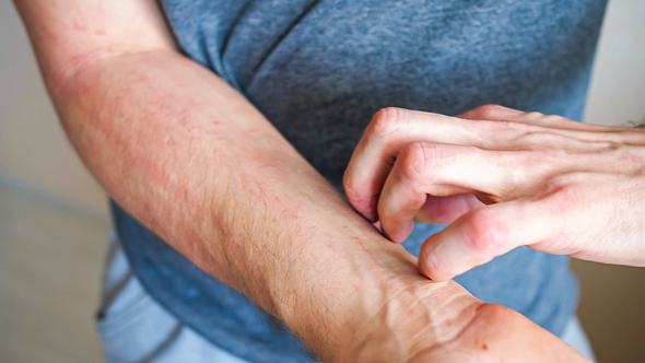 Mann kratzt sich am Unterarm - Foto: iStock/LENblR