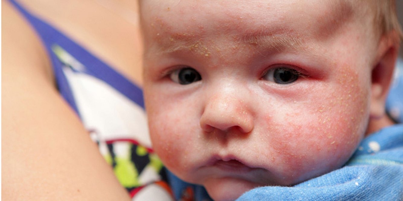 Die Ursache für schuppige Haut bei Babys kann nicht immer geklärt werden