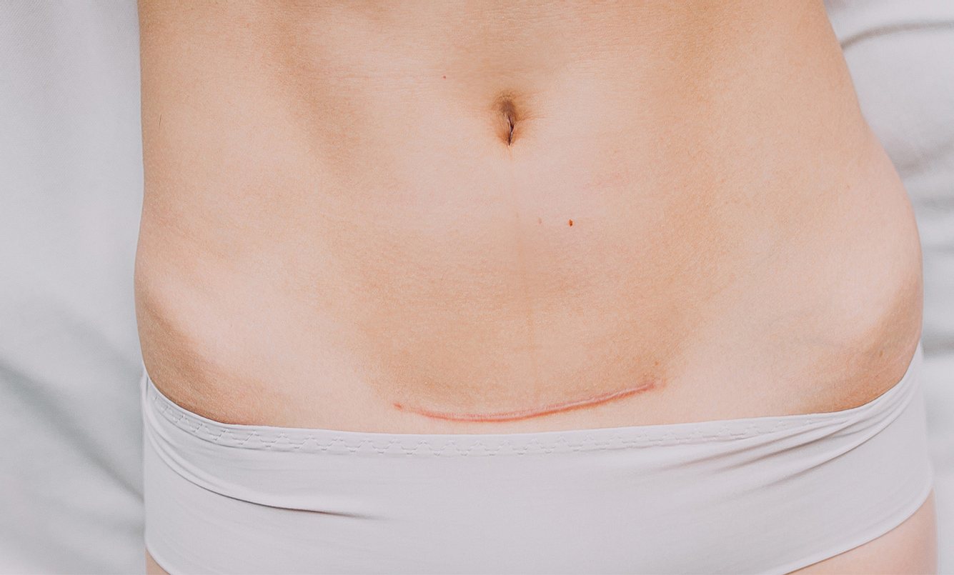 Bauch, Kaiserschnitt