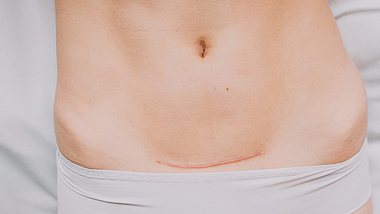 Bauch, Kaiserschnitt - Foto: iStock/dashamuller