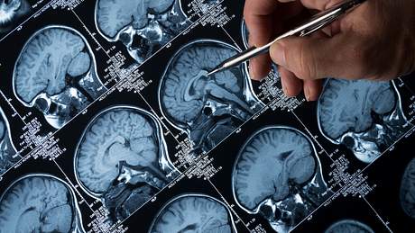 Gehirn-Scan im Detail - Foto: Istock/haydenbird